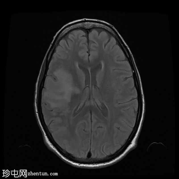 进行性多灶性白质脑病