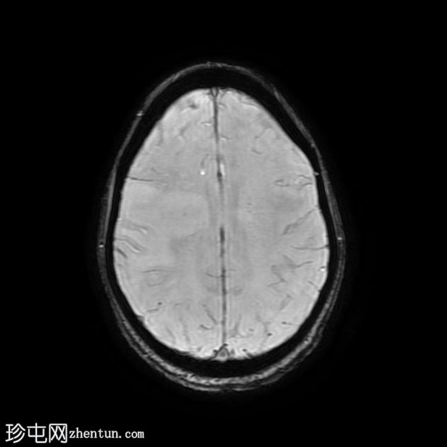 进行性多灶性白质脑病