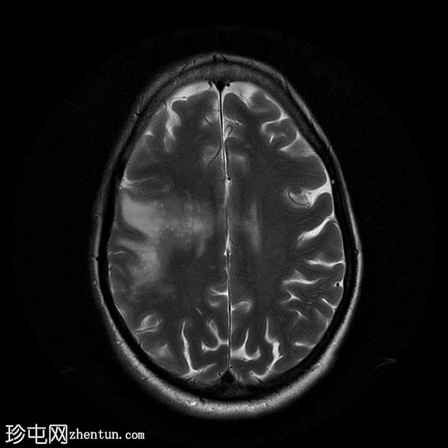 进行性多灶性白质脑病