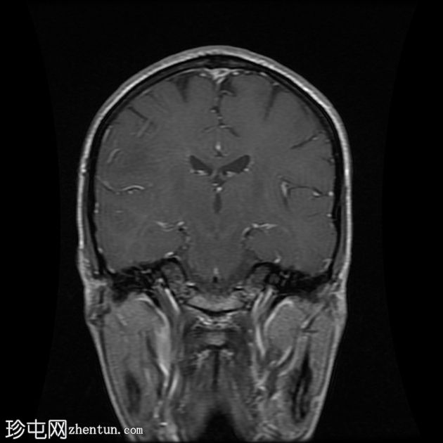 进行性多灶性白质脑病