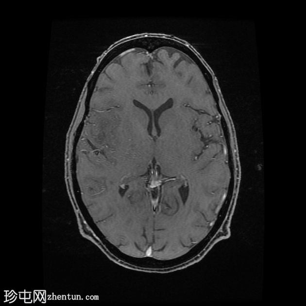 进行性多灶性白质脑病