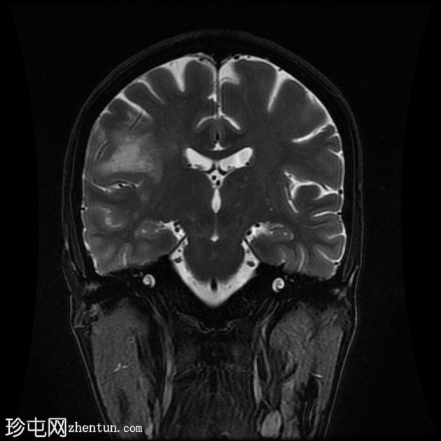 进行性多灶性白质脑病