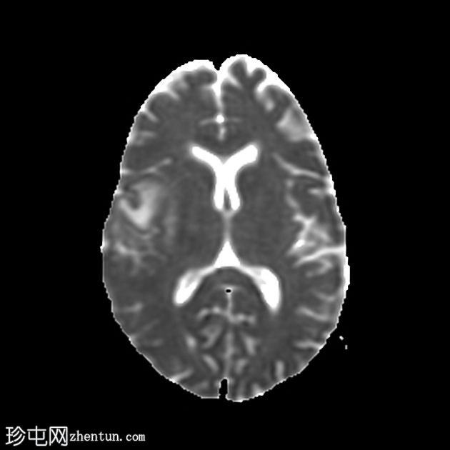 进行性多灶性白质脑病