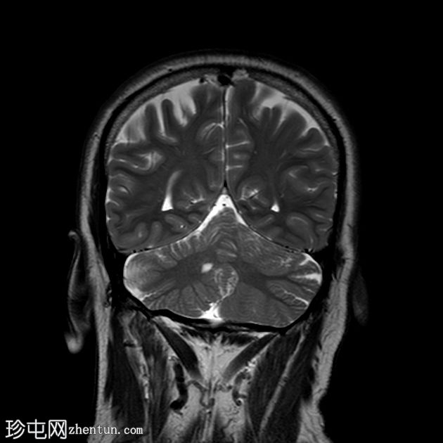 小脑皮质发育不良