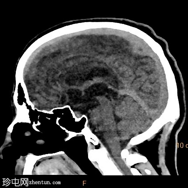 脑积水后胼胝体损伤