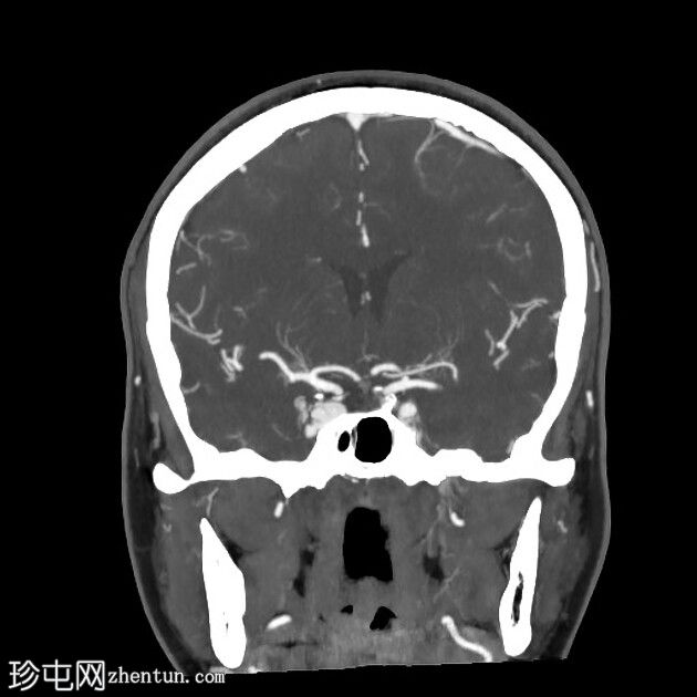 颈海绵窦瘘