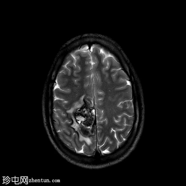 脑海绵状静脉畸形