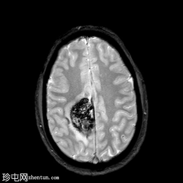 脑海绵状静脉畸形