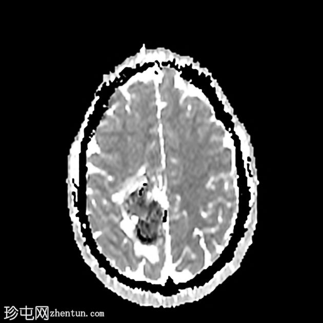 脑海绵状静脉畸形