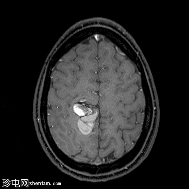 脑海绵状静脉畸形