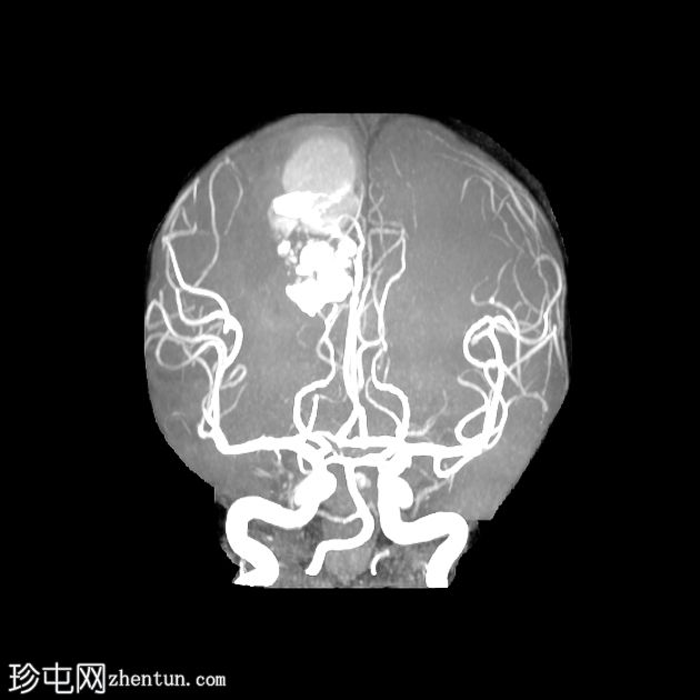 脑海绵状静脉畸形