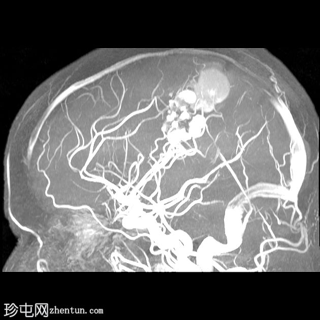 脑海绵状静脉畸形