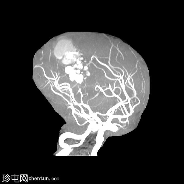 脑海绵状静脉畸形