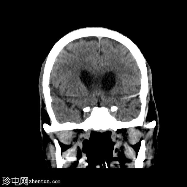 双侧小脑梗塞