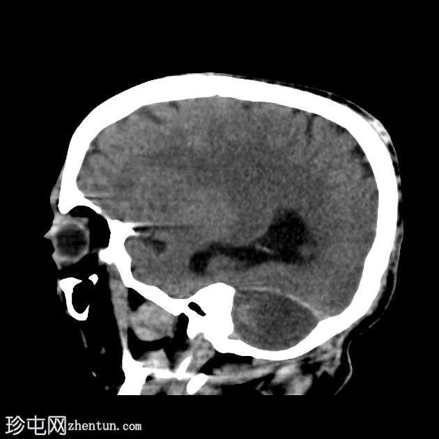 双侧小脑梗塞