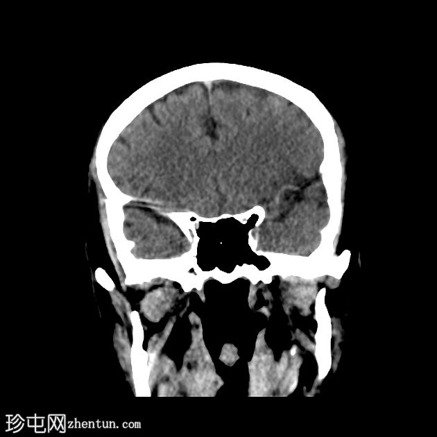 急性大脑中动脉缺血性卒中