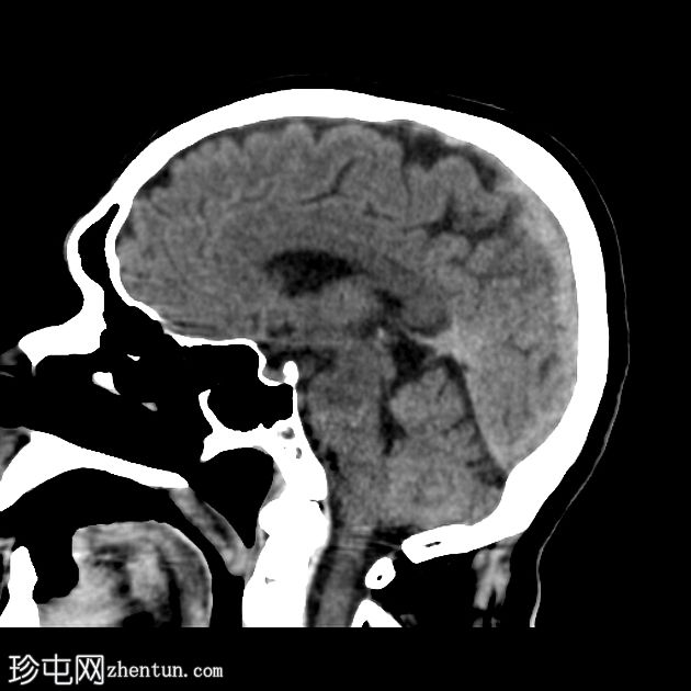 急性大脑中动脉缺血性卒中