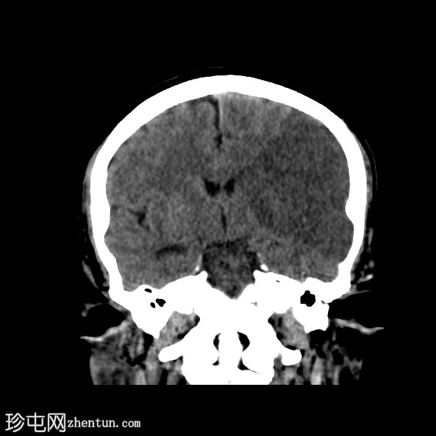 急性大脑中动脉缺血性卒中