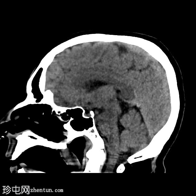 急性大脑中动脉缺血性卒中