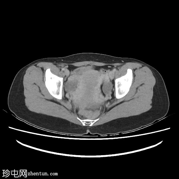 盆腔瘀血综合征