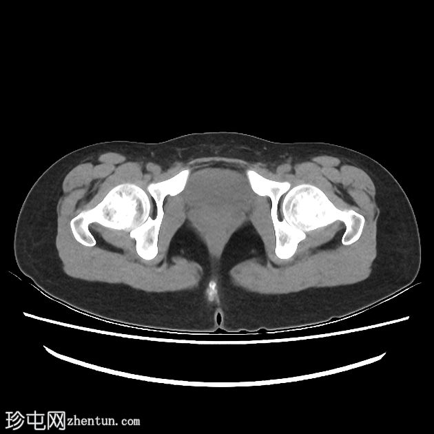 盆腔瘀血综合征