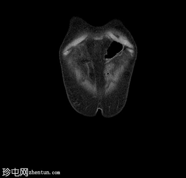 腹膜后气肿