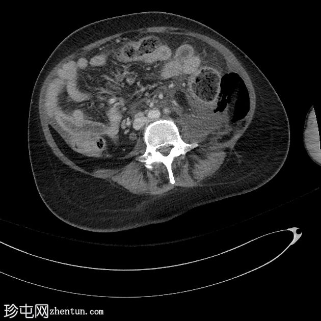 腹膜后气肿