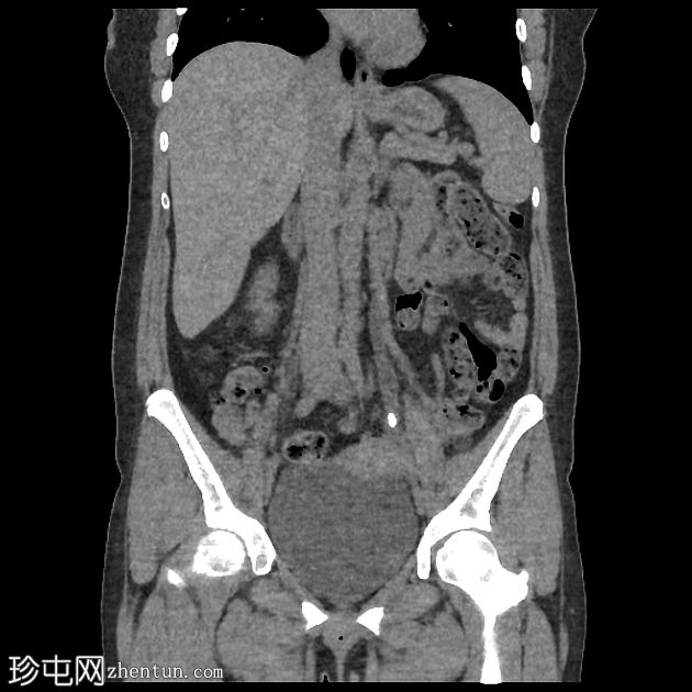 阻塞性输尿管结石（超声）