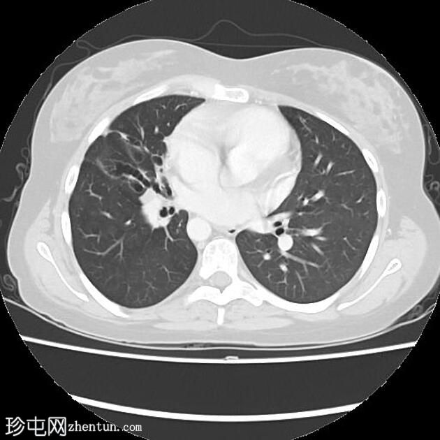 右侧主动脉弓伴有异常左锁骨下动脉