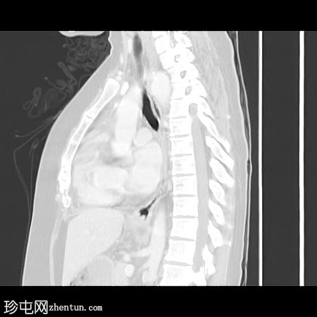 右侧主动脉弓伴有异常左锁骨下动脉