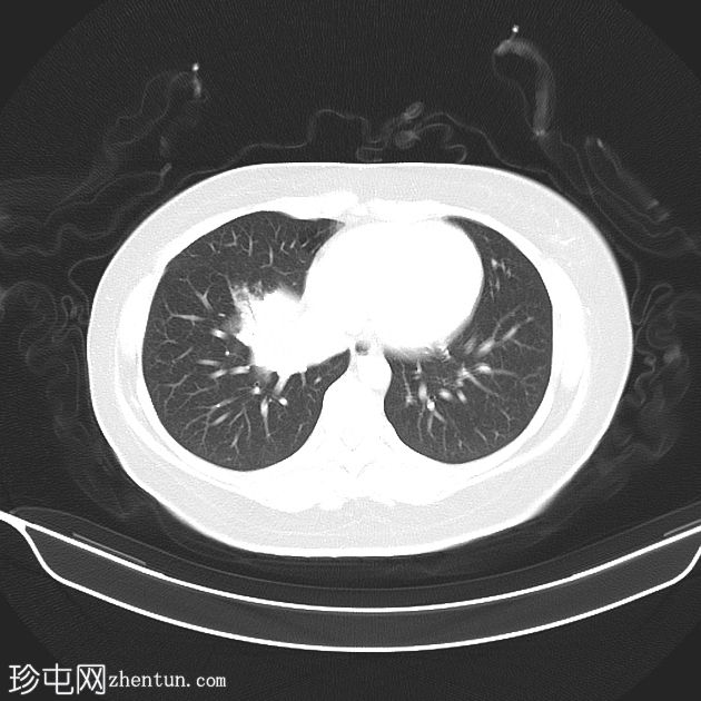 支原体肺炎——罕见