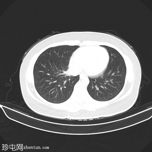 支原体肺炎——罕见