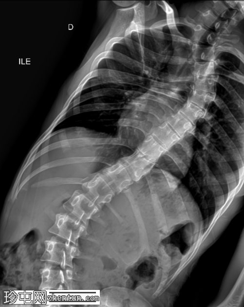 先天性脊柱侧弯 - 半段半椎体