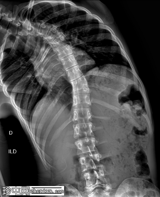 先天性脊柱侧弯 - 半段半椎体