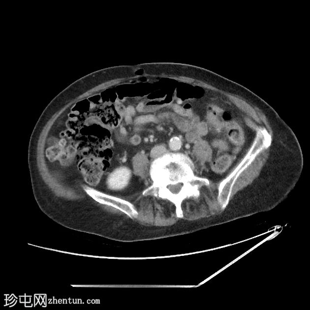 乙状结肠憩室穿孔