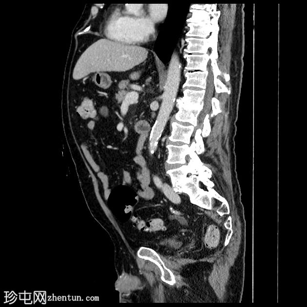 十二指肠溃疡-无穿孔