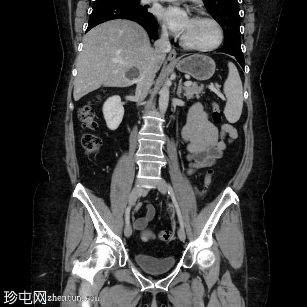 乙状结肠憩室炎 - 无并发症