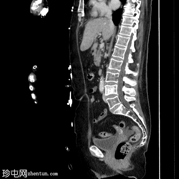 肾尿路上皮癌 - 转移性