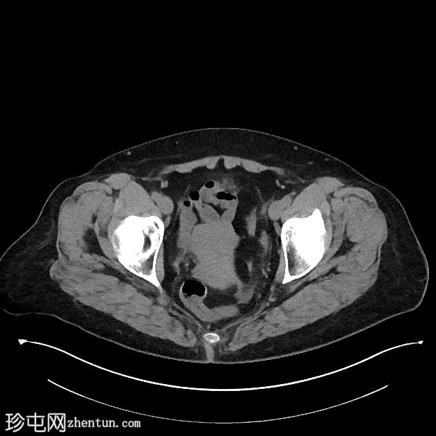 乳头状膀胱尿路上皮肿瘤