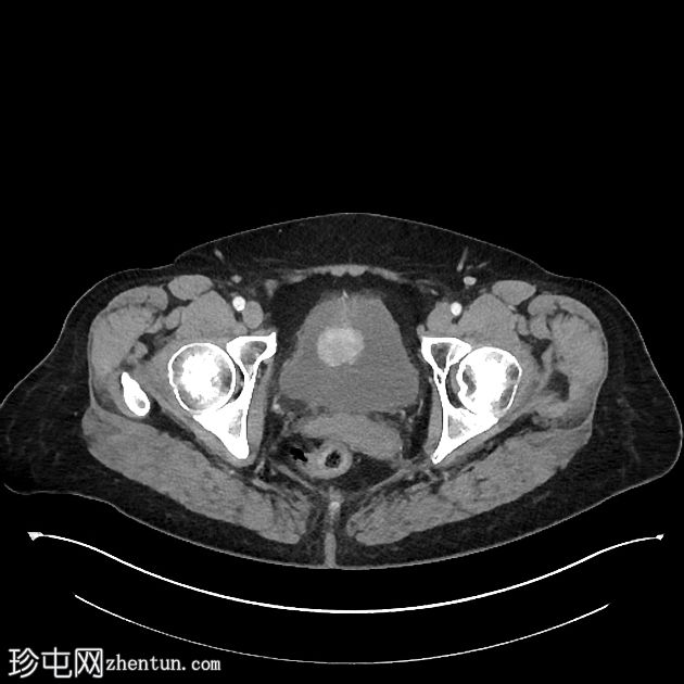 乳头状膀胱尿路上皮肿瘤