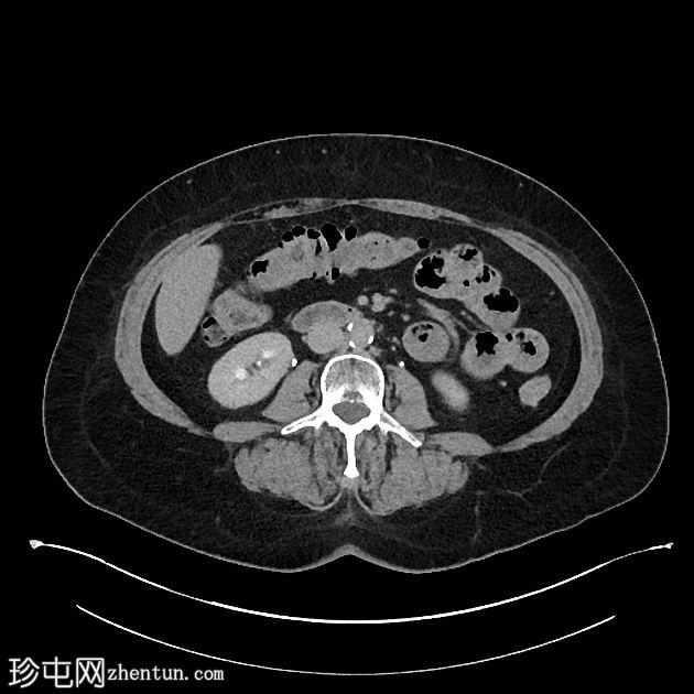 乳头状膀胱尿路上皮肿瘤