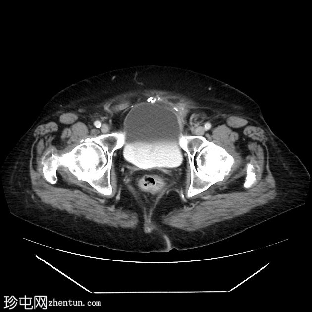 尿路上皮癌-膀胱壁增厚
