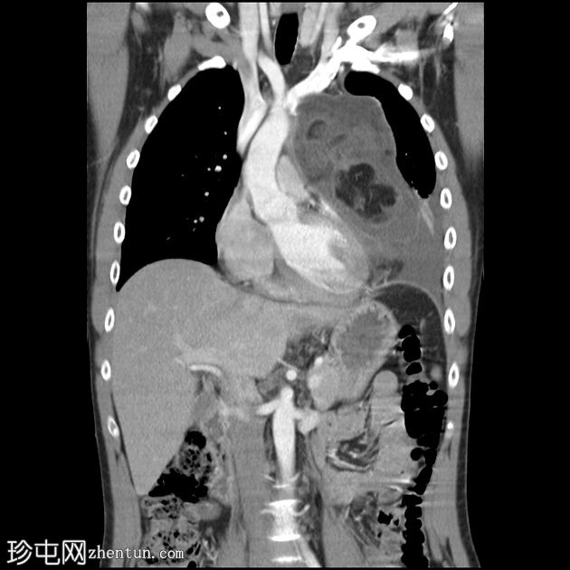 良性囊性畸胎瘤（纵隔）