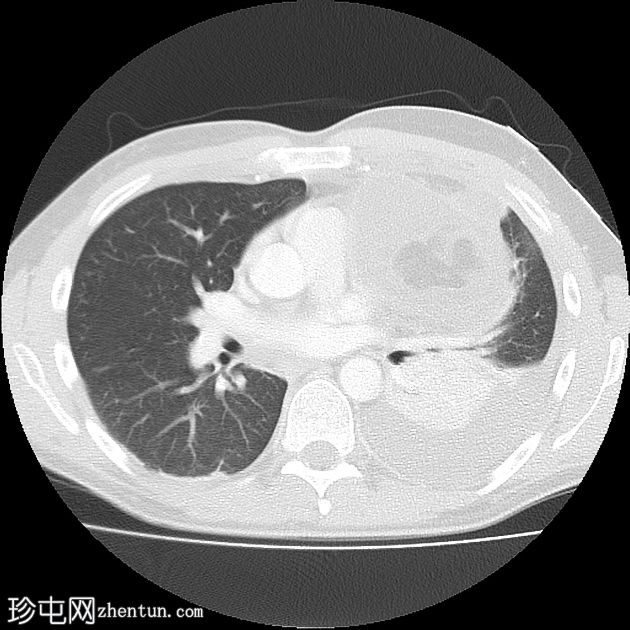 良性囊性畸胎瘤（纵隔）