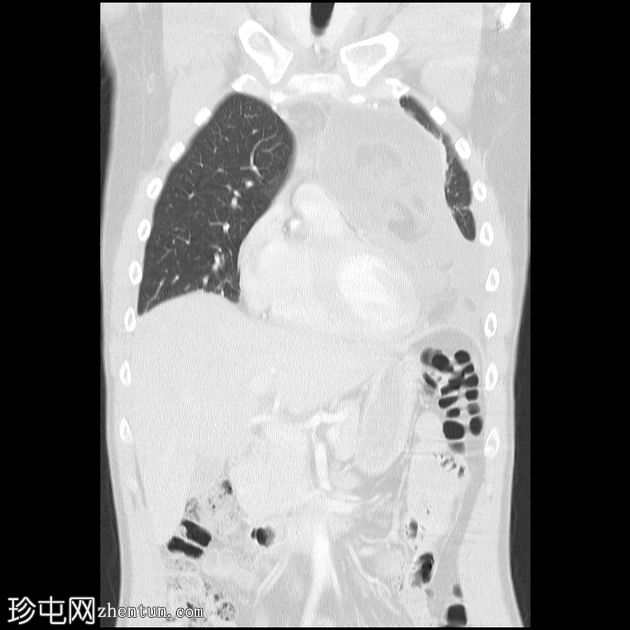 良性囊性畸胎瘤（纵隔）