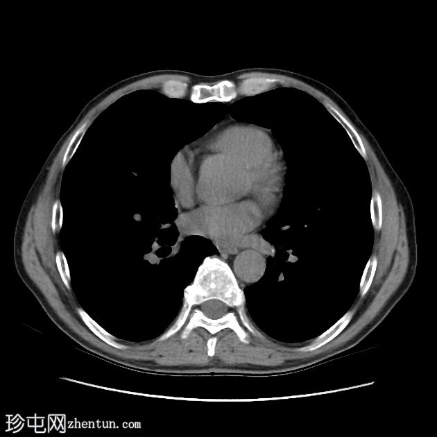 慢性阻塞性肺病-α-1-抗胰蛋白酶缺乏症