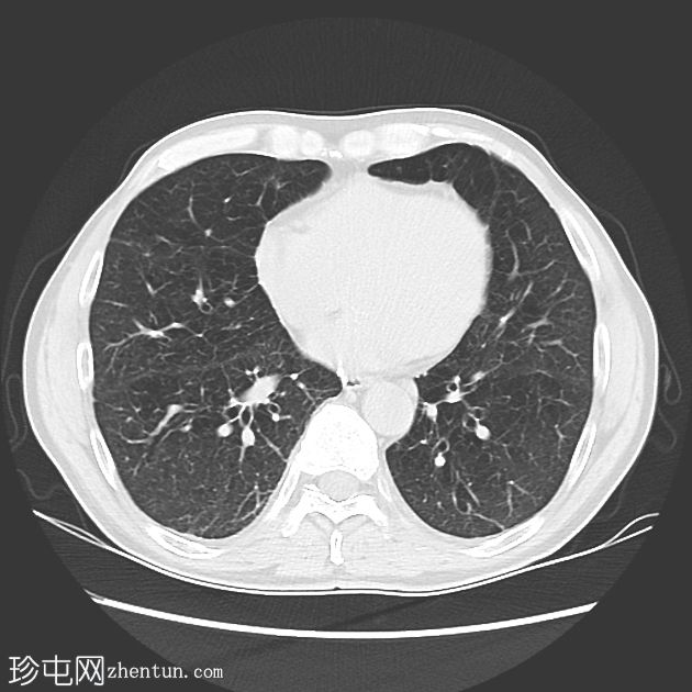 慢性阻塞性肺病-α-1-抗胰蛋白酶缺乏症