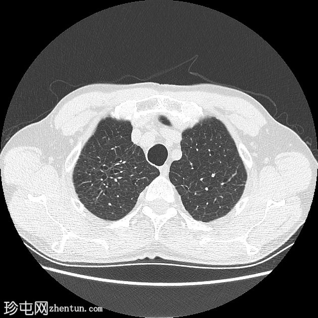 慢性阻塞性肺病-α-1-抗胰蛋白酶缺乏症