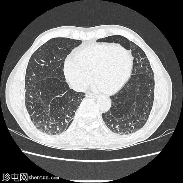 慢性阻塞性肺病-α-1-抗胰蛋白酶缺乏症