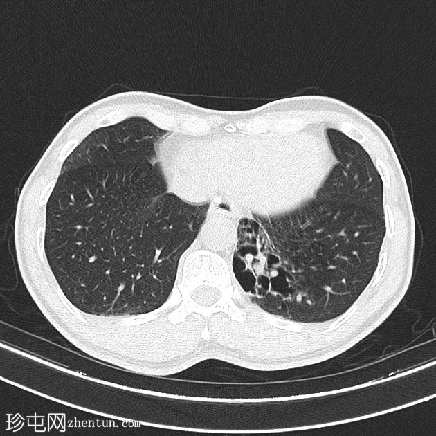 叶内型肺隔离症